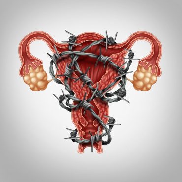 Endometriosis & LPG Endermologie at Flux Skin Clinic